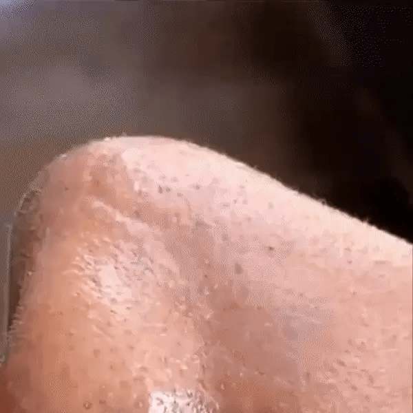 PureSkin Pro™ – Verwijdert Onzuiverheden in Slechts Enkele Minuten