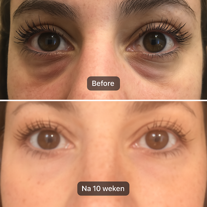 Hyaluronzuur microneedle oogpatches - Verjong, hydrateer & verzorg je ogen!