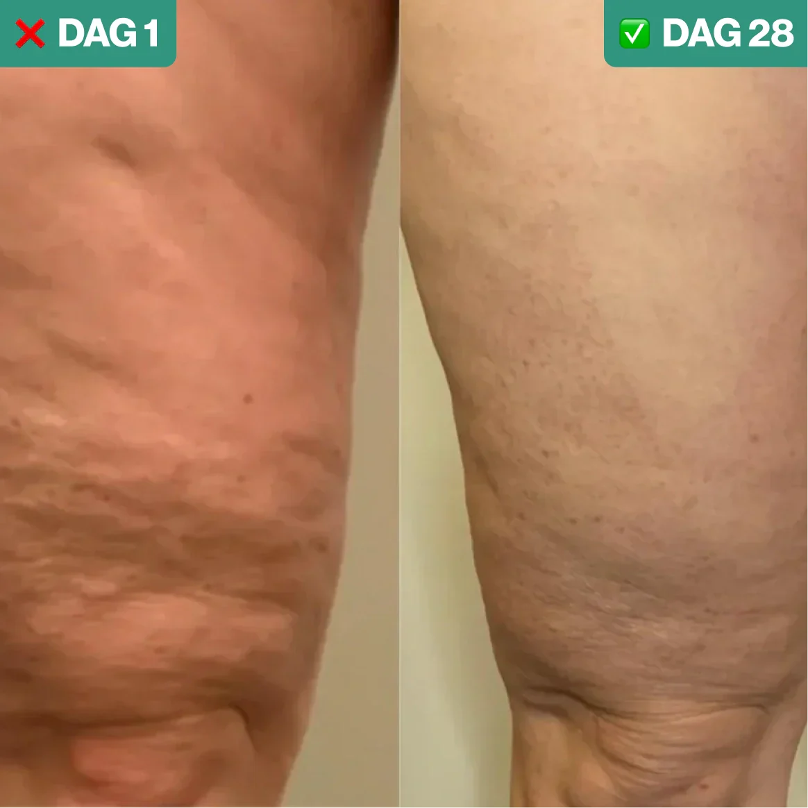 CelluLift Pro™ | Cellulitis Verwijderaar & Huidversteviger